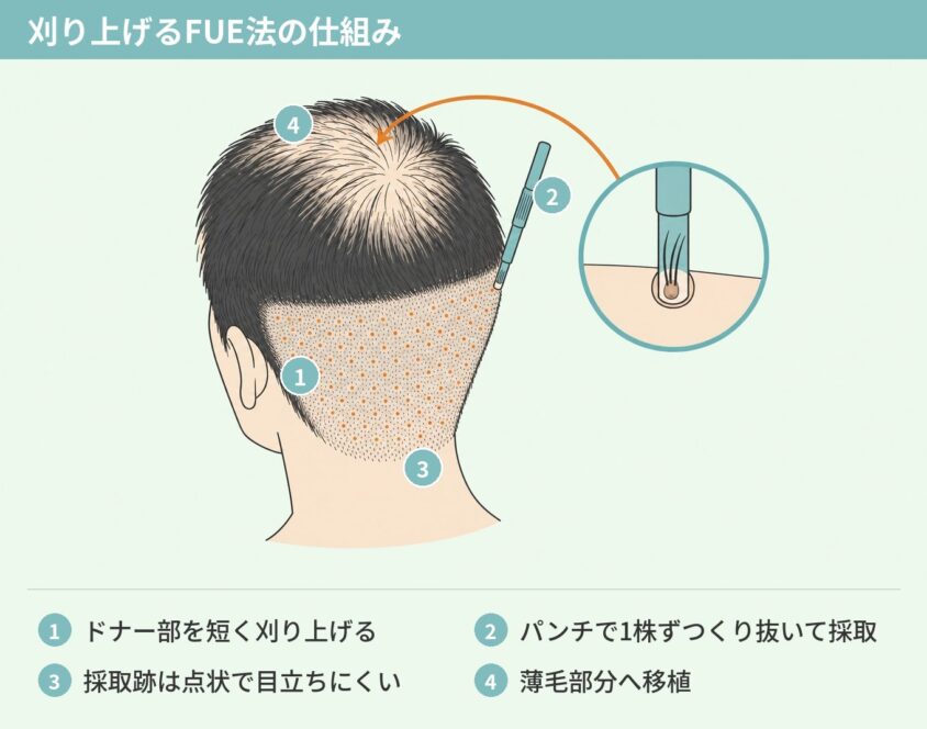 刈り上げるFUE法の仕組みを示した図解